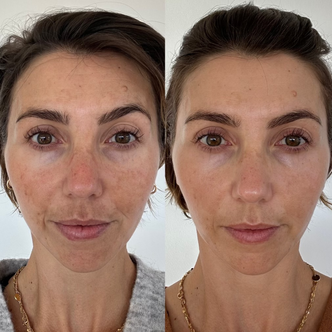 Combo Set – For Melasma, Pigmentation, and Dark Spots Gone! - Modarak Qatar