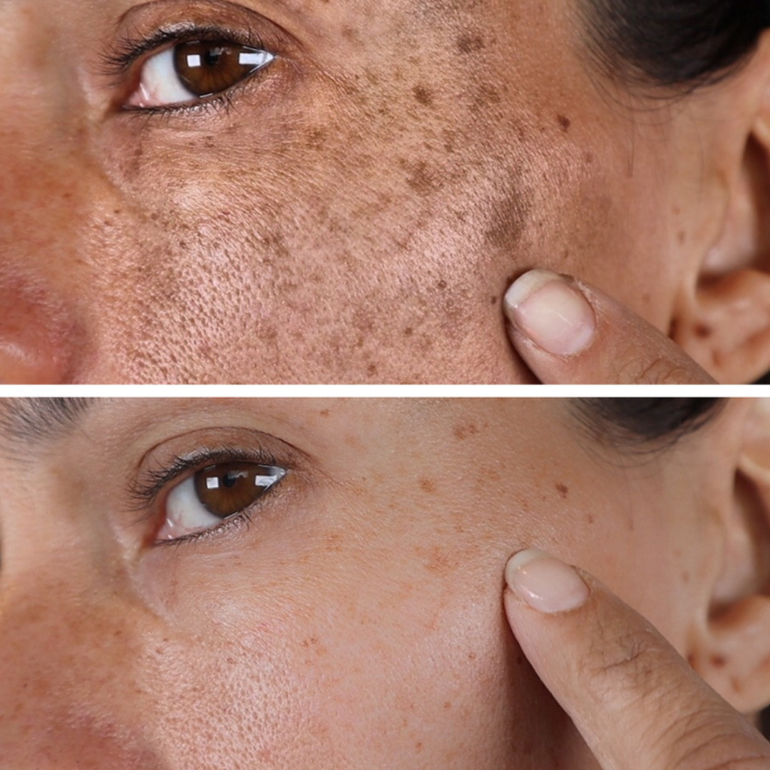 Combo Set – For Melasma, Pigmentation, and Dark Spots Gone! - Modarak Qatar