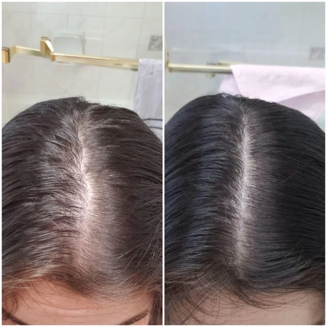 Rogaine for Women - Hair Regrowth 5% Minoxidil Foam 2 Month Supply - Modarak Qatar