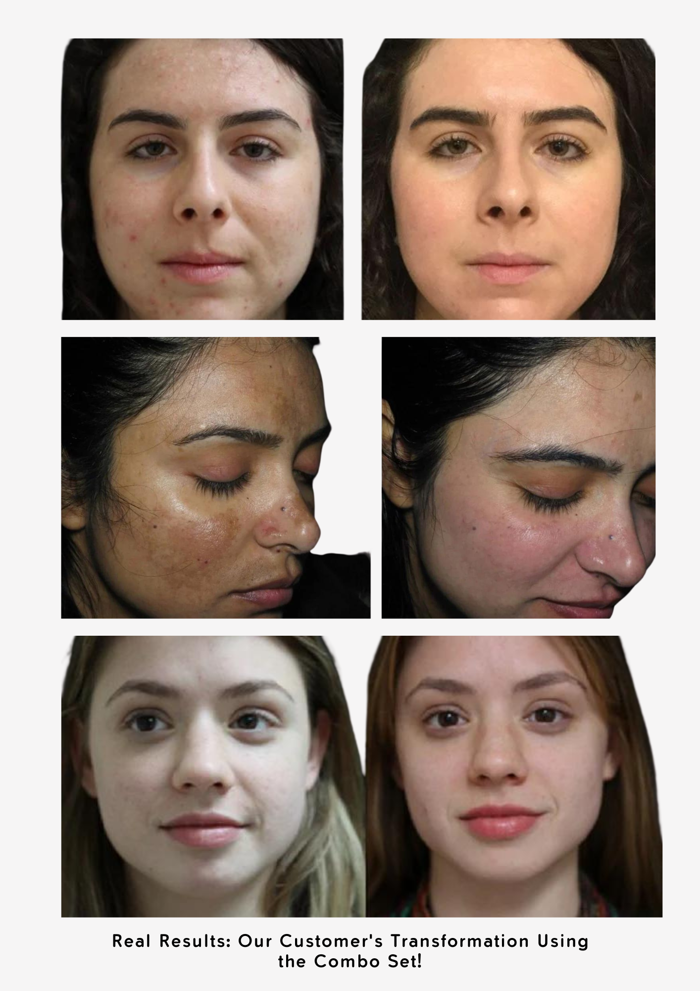 Combo Set – For Melasma, Pigmentation, and Dark Spots Gone! - Modarak Qatar