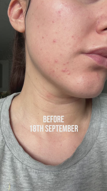 CeraVe Blemish Control Gel